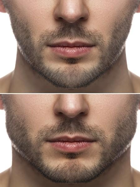 Jawline Contouring à Liège : redessiner sa mâchoire