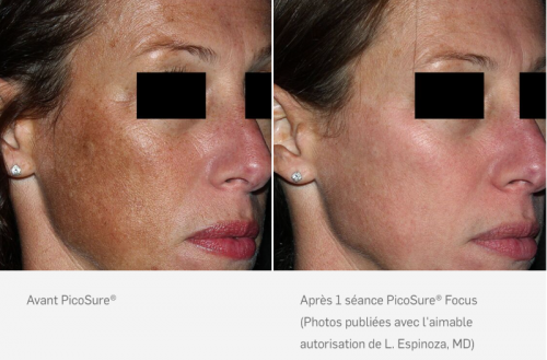 Rajeunissement cutané du visage au laser PicoSure® Focus - Liège