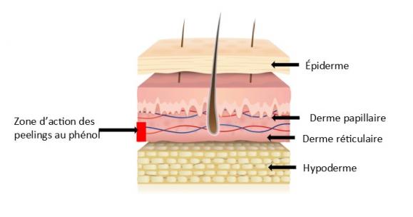 peeling profond