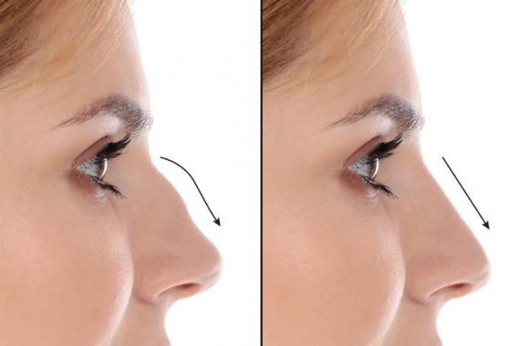 rhinoplastie