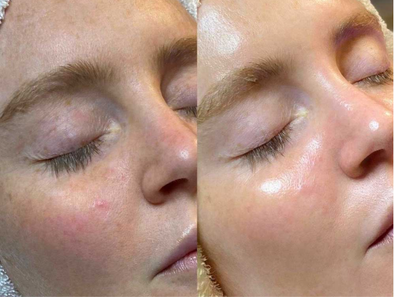 résultat hydrafacial
